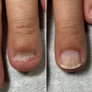 明石市の深爪矯正専門サロン｜深爪・噛み爪・むしり癖でお悩みならトレフル