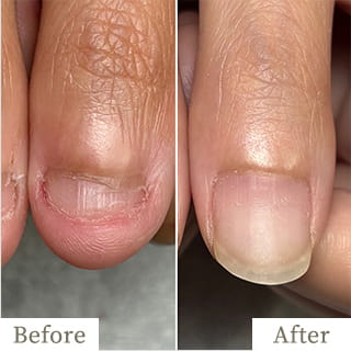 明石市の深爪矯正専門サロン｜深爪・噛み爪・むしり癖でお悩みならトレフル