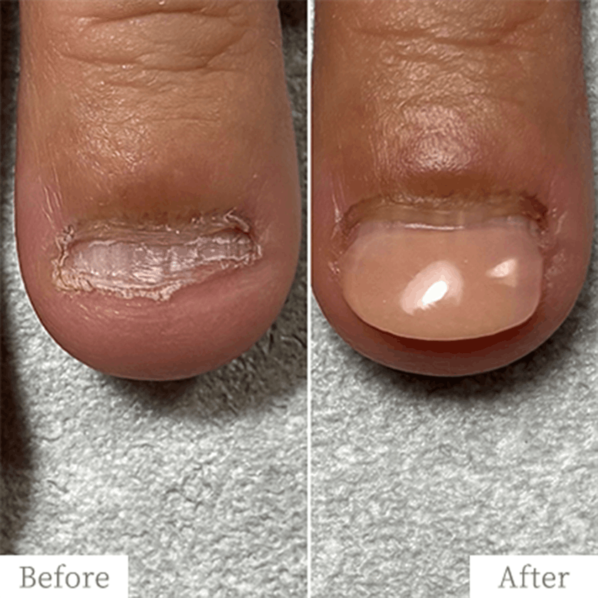 明石市の深爪矯正専門サロン｜深爪・噛み爪・むしり癖でお悩みならトレフル