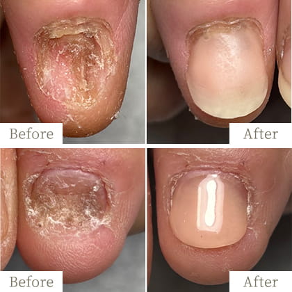 明石市の深爪矯正専門サロン｜深爪・噛み爪・むしり癖でお悩みならトレフル