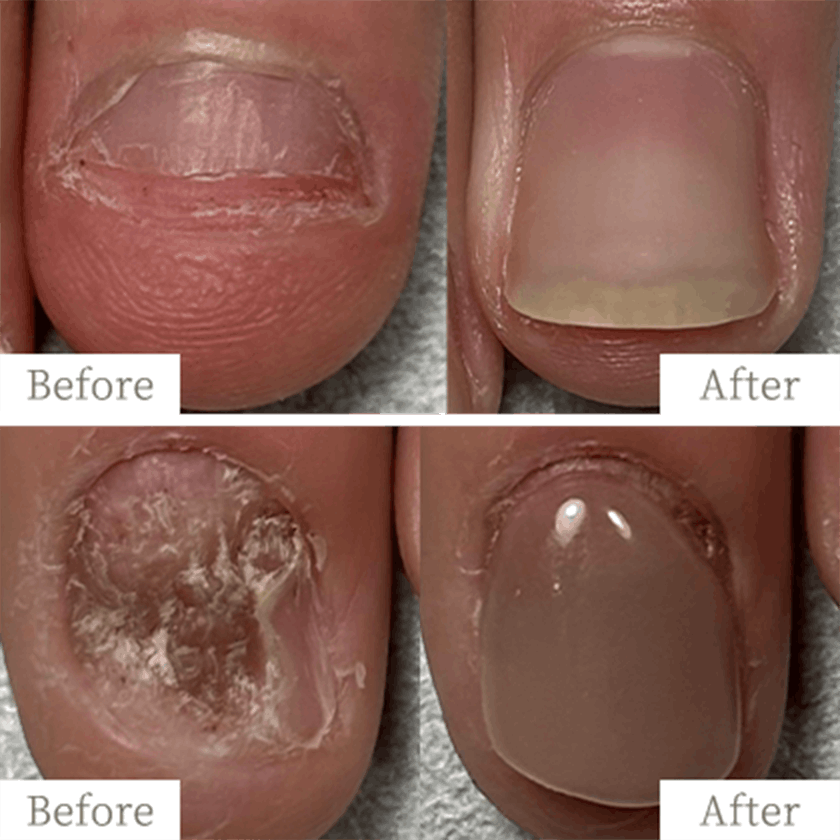 明石市の深爪矯正専門サロン｜深爪・噛み爪・むしり癖でお悩みならトレフル