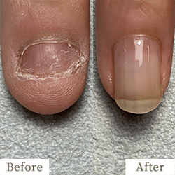 明石市の深爪矯正専門サロン｜深爪・噛み爪・むしり癖でお悩みならトレフル