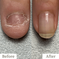 明石市の深爪矯正専門サロン｜深爪・噛み爪・むしり癖でお悩みならトレフル