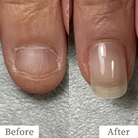 明石市の深爪矯正専門サロン｜深爪・噛み爪・むしり癖でお悩みならトレフル