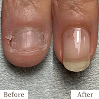 明石市の深爪矯正専門サロン｜深爪・噛み爪・むしり癖でお悩みならトレフル