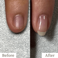 明石市の深爪矯正専門サロン｜深爪・噛み爪・むしり癖でお悩みならトレフル