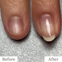 明石市の深爪矯正専門サロン｜深爪・噛み爪・むしり癖でお悩みならトレフル