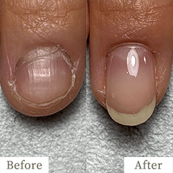 明石市の深爪矯正専門サロン｜深爪・噛み爪・むしり癖でお悩みならトレフル