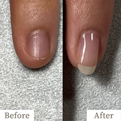 明石市の深爪矯正専門サロン｜深爪・噛み爪・むしり癖でお悩みならトレフル