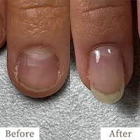 明石市の深爪矯正専門サロン｜深爪・噛み爪・むしり癖でお悩みならトレフル