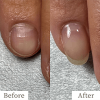 明石市の深爪矯正専門サロン｜深爪・噛み爪・むしり癖でお悩みならトレフル