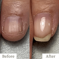 明石市の深爪矯正専門サロン｜深爪・噛み爪・むしり癖でお悩みならトレフル