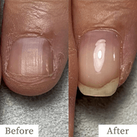 明石市の深爪矯正専門サロン｜深爪・噛み爪・むしり癖でお悩みならトレフル