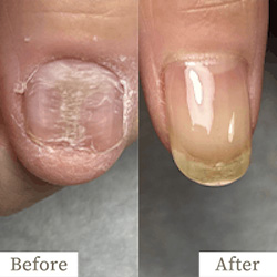 明石市の深爪矯正専門サロン｜深爪・噛み爪・むしり癖でお悩みならトレフル